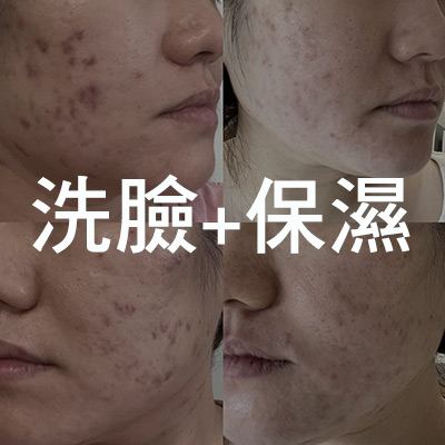 新加坡案例分享：洗臉+保濕做對，肌膚就會明顯進步！