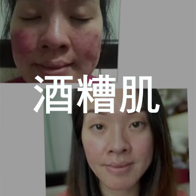 香港顧客：酒糟肌膚困擾6年，花費驚人， 改採用ELSA的保養法，半年內的改善讓我覺得自己像遇到了白馬王子一樣開心！