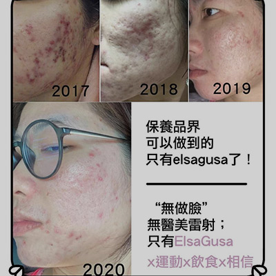 2018 EMMA 開始修補凹疤，2019已經驚人修復了不少，2020的現在，她更好了，這一切，沒有任何做臉、醫美，也沒有吃藥擦藥打針，重點還是在於停止破壞自己的臉